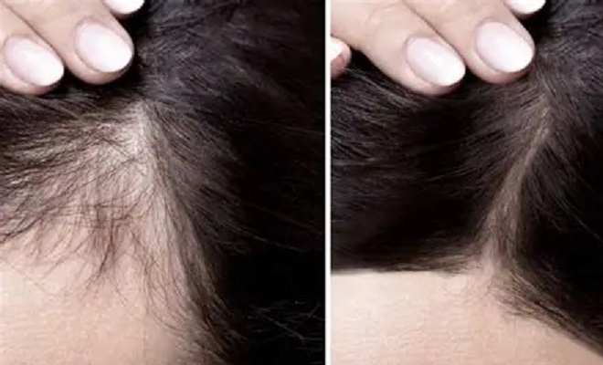 Why Consider a Natural Hair Loss Treatment? 